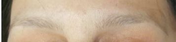 Eyebrow Microblading - MD Esthetics - microblading_before